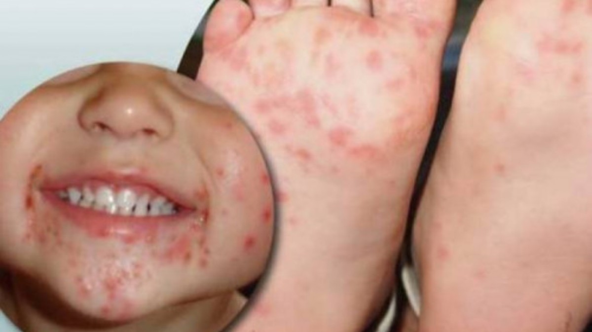 Síndrome “Mão, pé e boca” afeta moradores de Cuiabá e prefeitura alerta