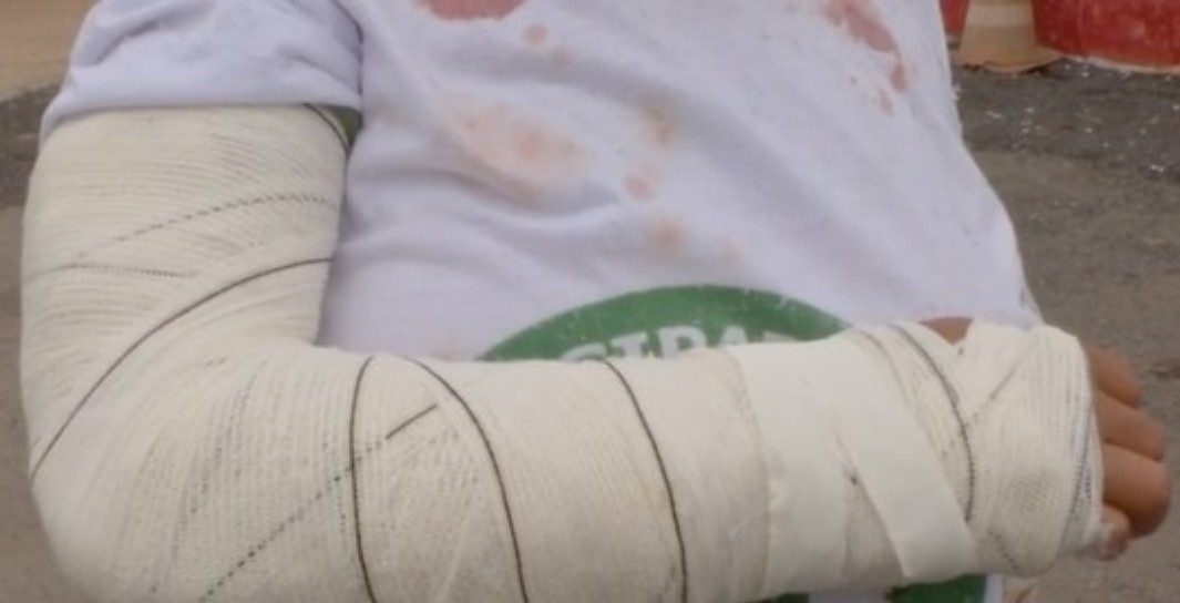 Mulher tem braço quebrado e cortes na cabeça ao ser agredida pelo marido: ‘É a quinta vez’