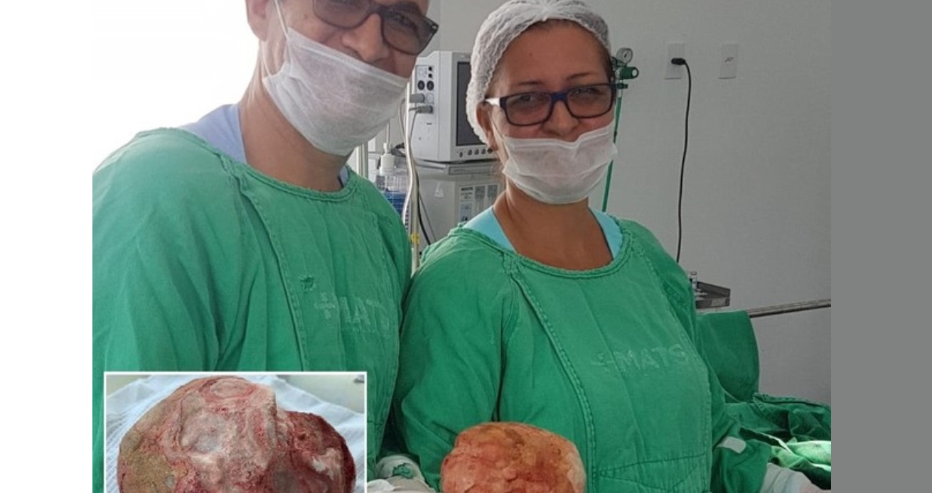 Lavrador de 51 anos tem pedra de 1,3 Kg e 18 cm retirada da bexiga em cirurgia na Bahia