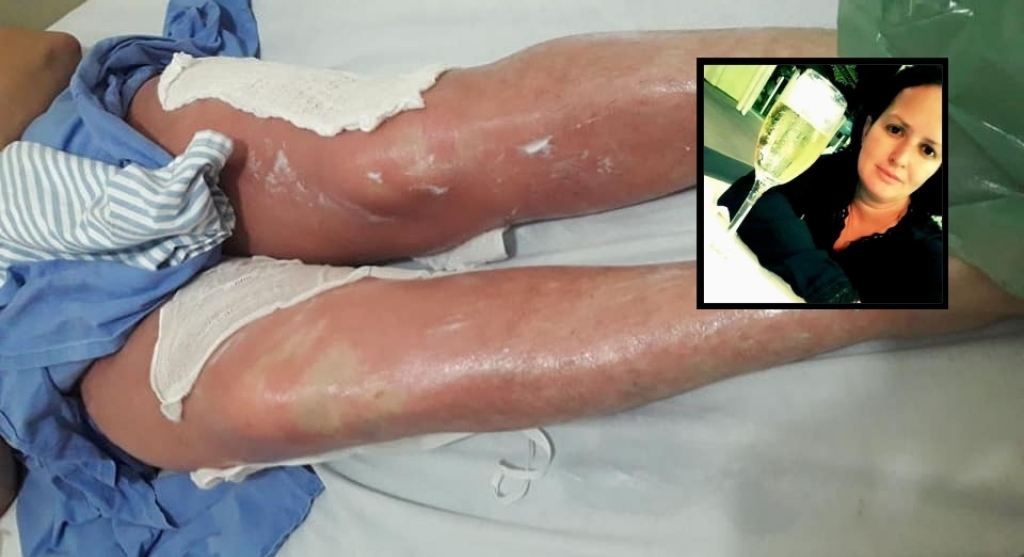 Mulher tem queimaduras em 75% do corpo após bronzeamento