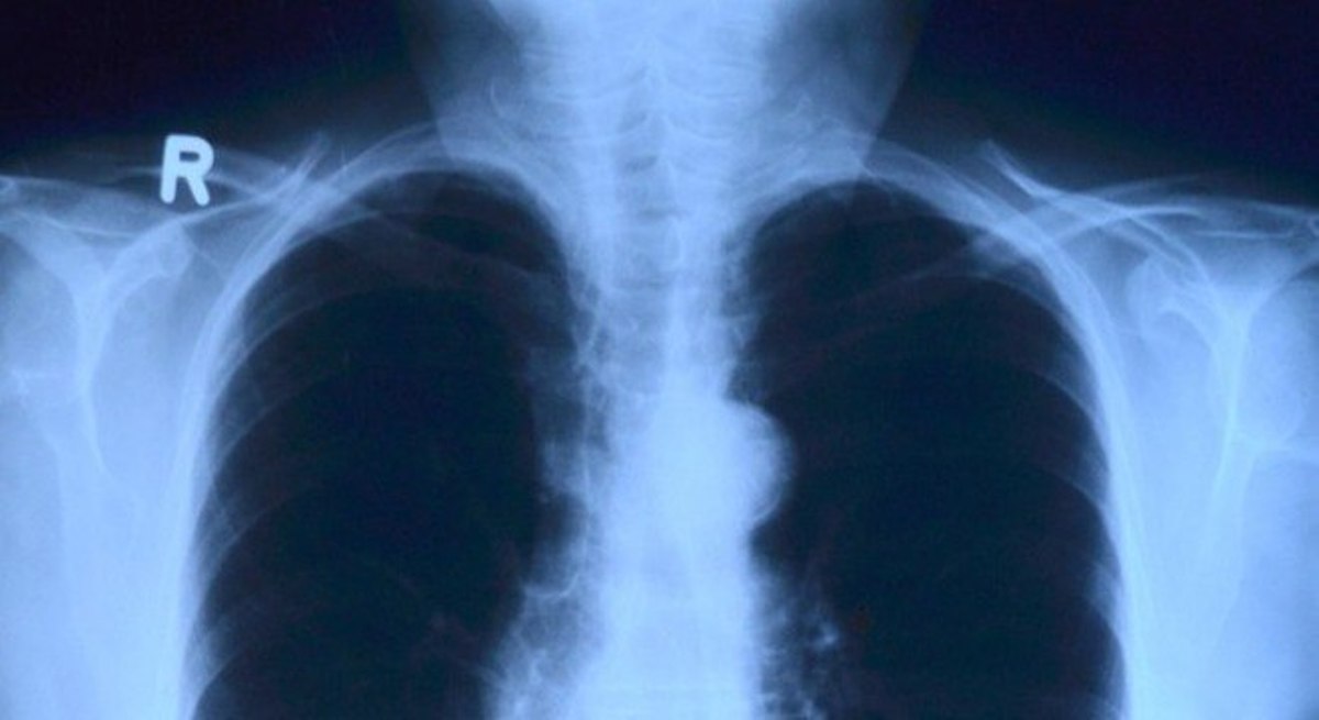 Câncer de pulmão mais comum no país ganha tratamento combinado