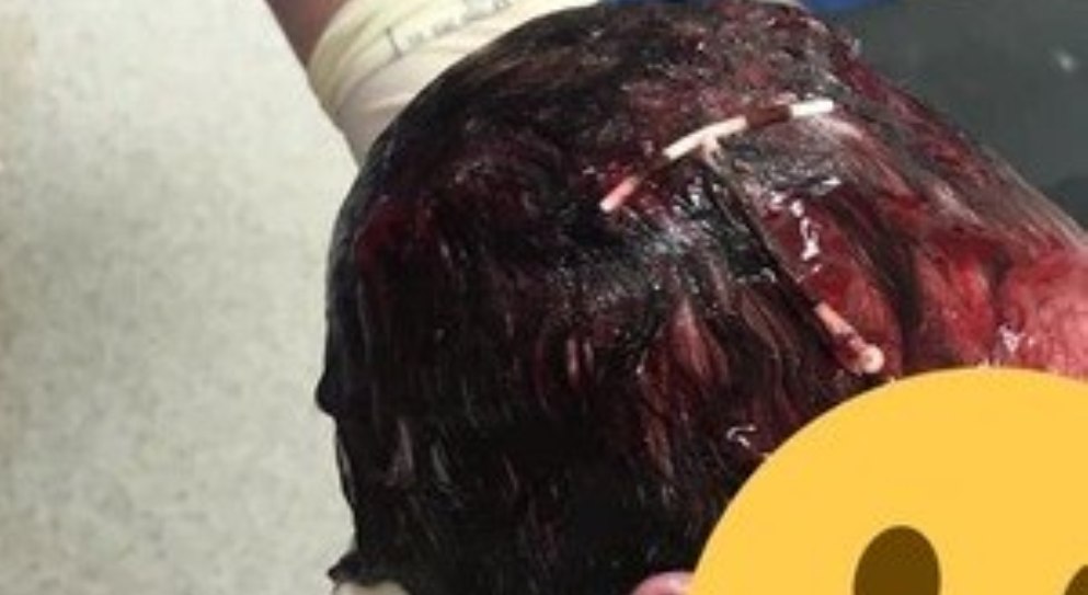 Bebê nasce com DIU preso no cabelo. Médico explica o caso