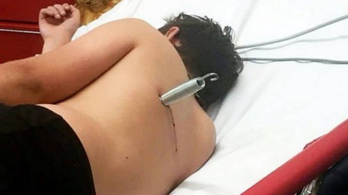 Defeito em cama elástica deixa adolescente com mola cravada nas costas