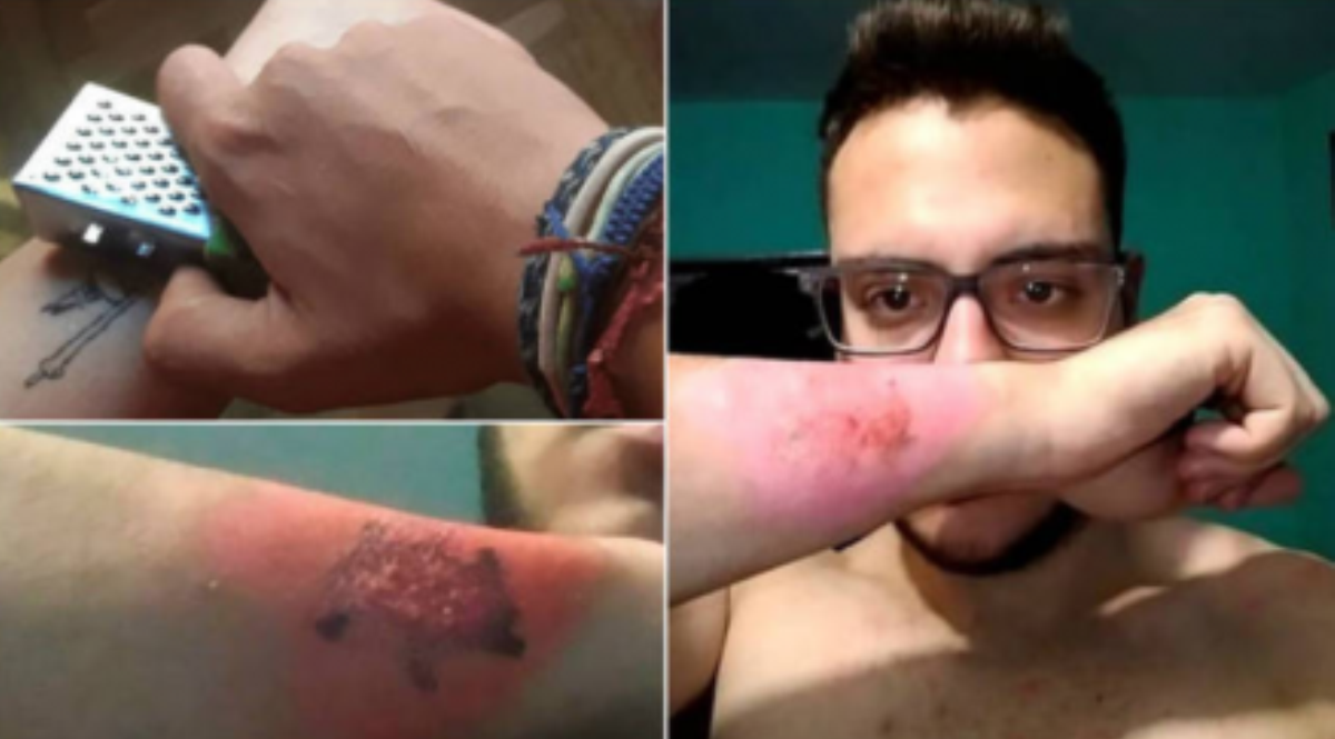 Jovem faz tatuagem, se arrepende e a remove com ralador