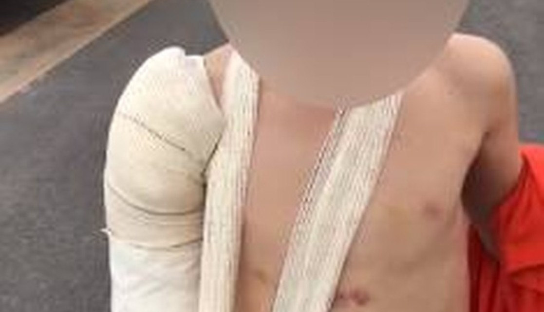 Preso por tortura e cárcere obrigou enteado de 6 anos a dizer em vídeo que tinha quebrado braço em acidente