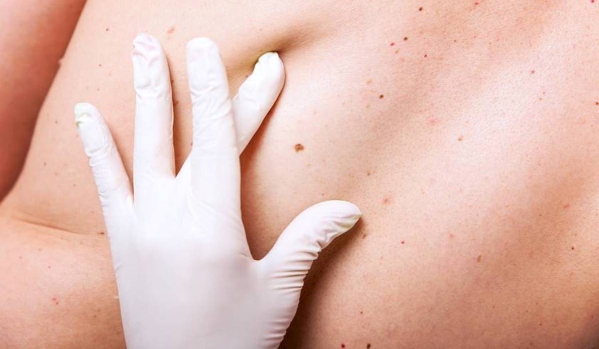 No Brasil a cada 3 horas um morre de câncer de pele