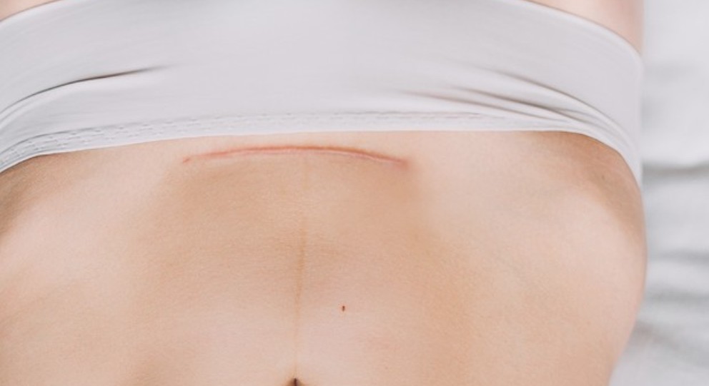 Anestesia geral durante cesarianas aumenta risco de depressão pós-parto