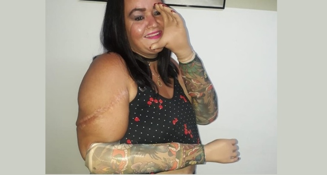 Mulher que teve mãos decepadas pelo marido ganha próteses