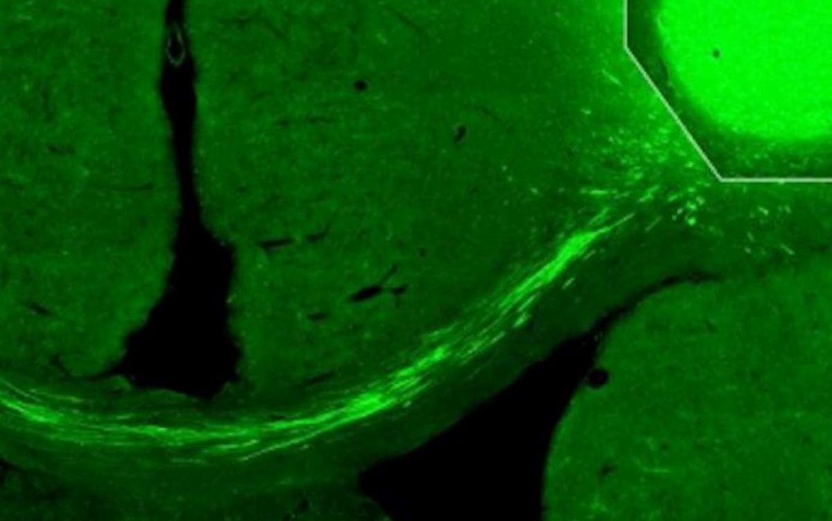 Cientistas revertem danos de AVC com células da pele humana