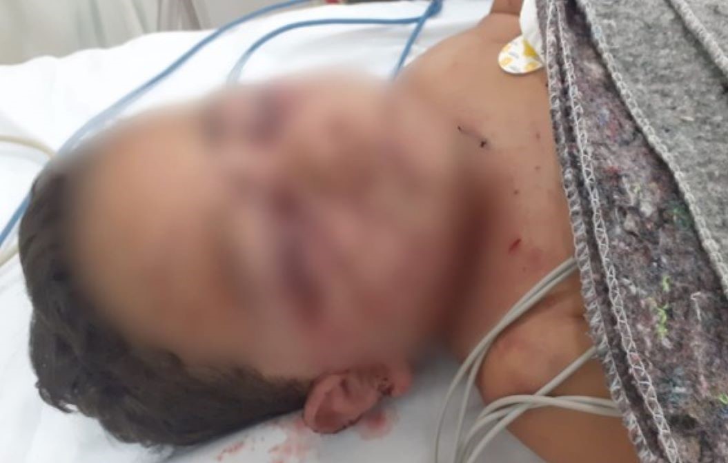 Sorriso | Menino de 2 anos é internado com ferimentos graves após ser atacado por cachorro