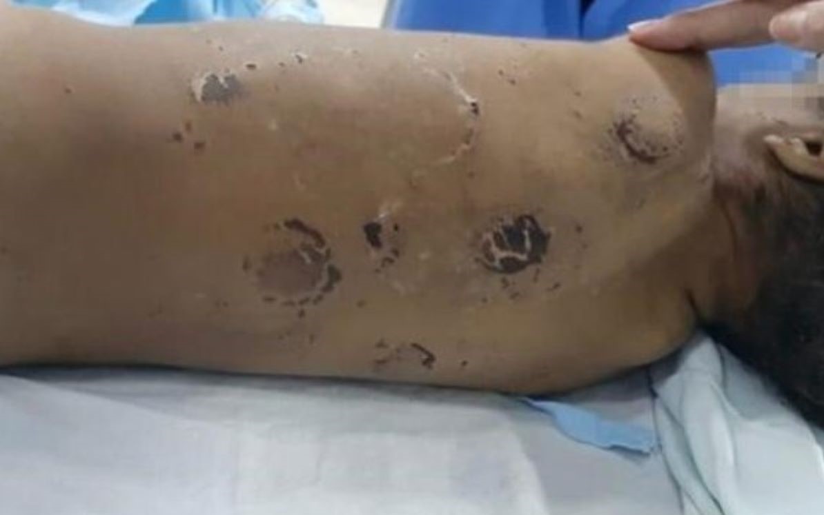 Rondonópolis | Menino de 2 anos vai para UTI com traumatismo craniano e fratura nas costelas por maus-tratos dos pais
