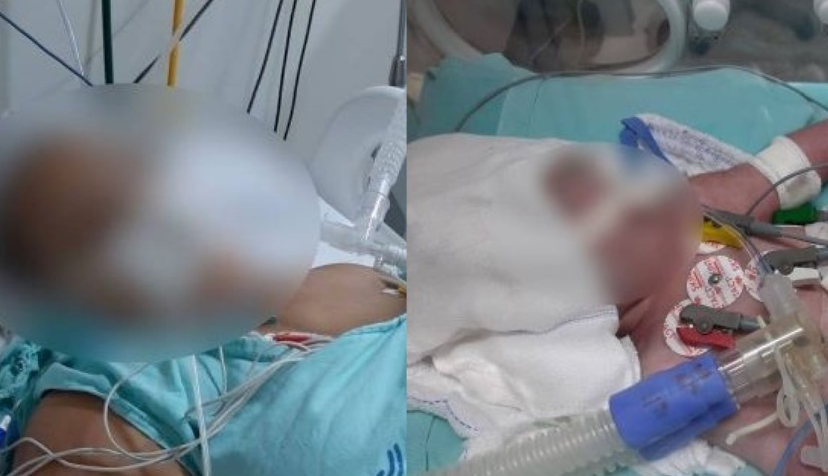 Rondonópolis | Mãe e filha estão em estado grave na UTI após parto
