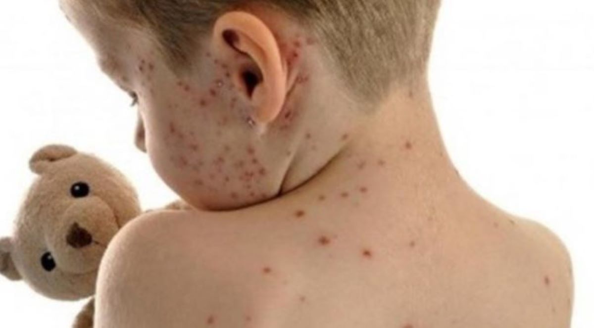 Rondonópolis | Município convoca população para tomar vacina contra sarampo