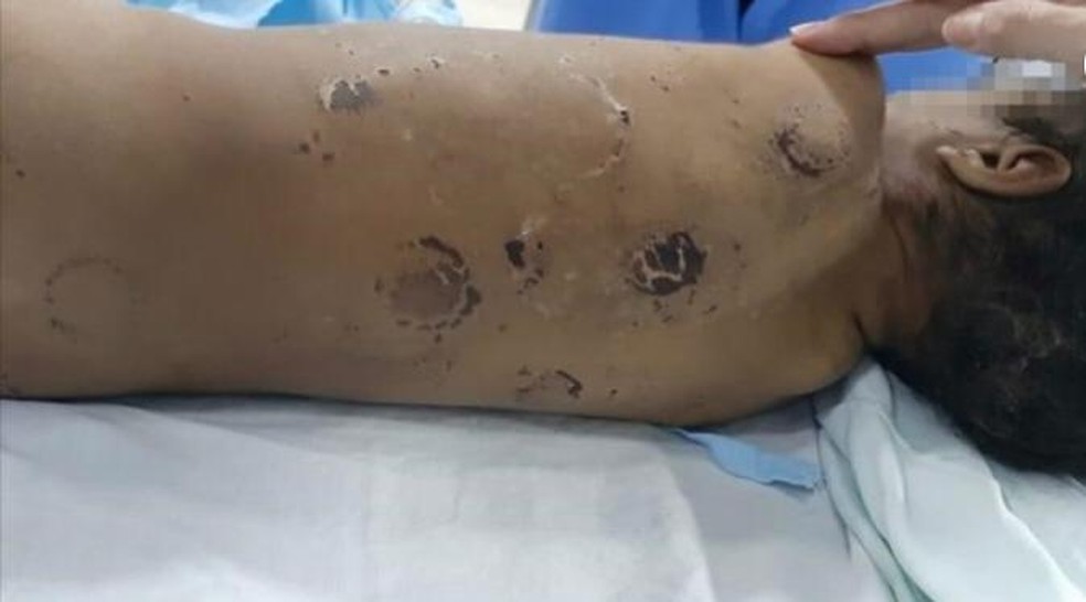 Rondonópolis | Menino de 2 anos que sofreu traumatismo e fratura nas costelas por maus-tratos dos pais tem alta