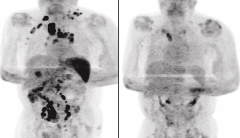 Após contrair Covid-19, homem tem redução de câncer em estágio avançado