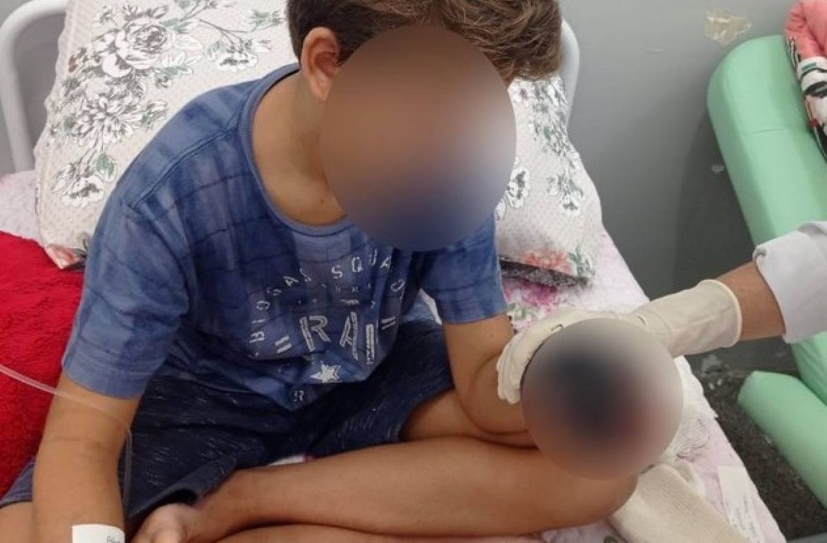 Várzea Grande | Menino de 10 anos que se acidentou em parquinho tem dois dedos amputados