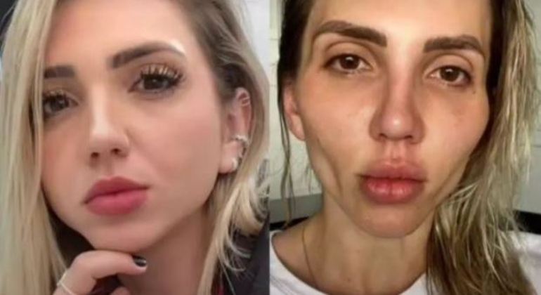 Influenciadora se arrepende de bichectomia: “Minha cara caiu”