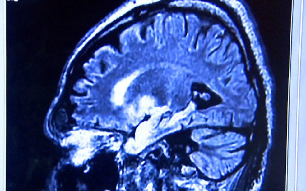 Mato Grosso registrou 140 casos de câncer cerebral em 2020