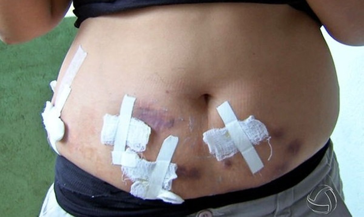 Cuiabá | Clínica é condenada a indenizar 52 pacientes contaminados em procedimentos estéticos