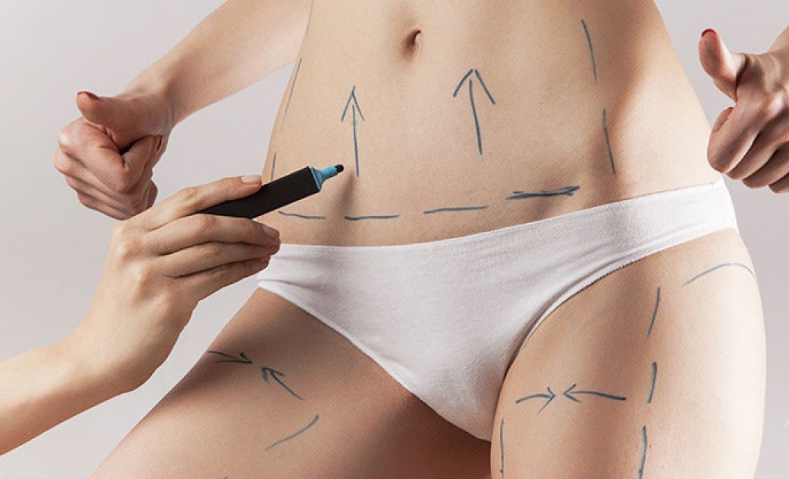 Resultado da Lipo só é duradouro quando se muda hábitos de vida