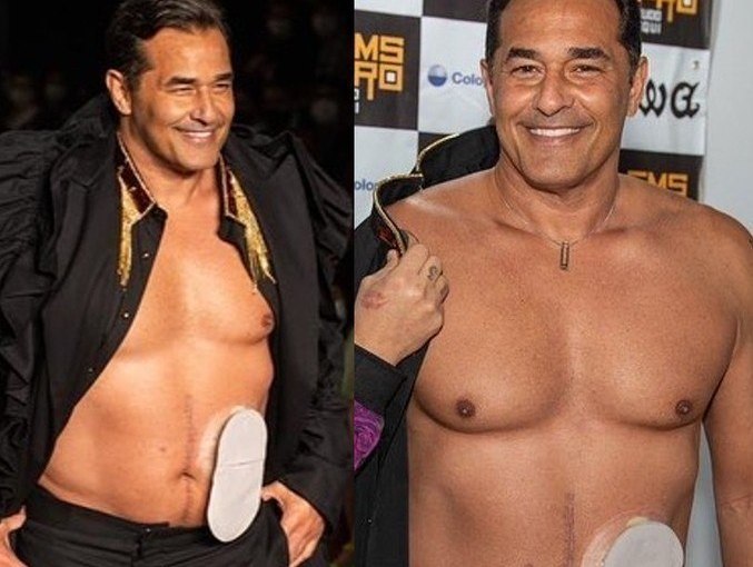 ‘Meta realizada’, diz Szafir após desfile com bolsa de estomia