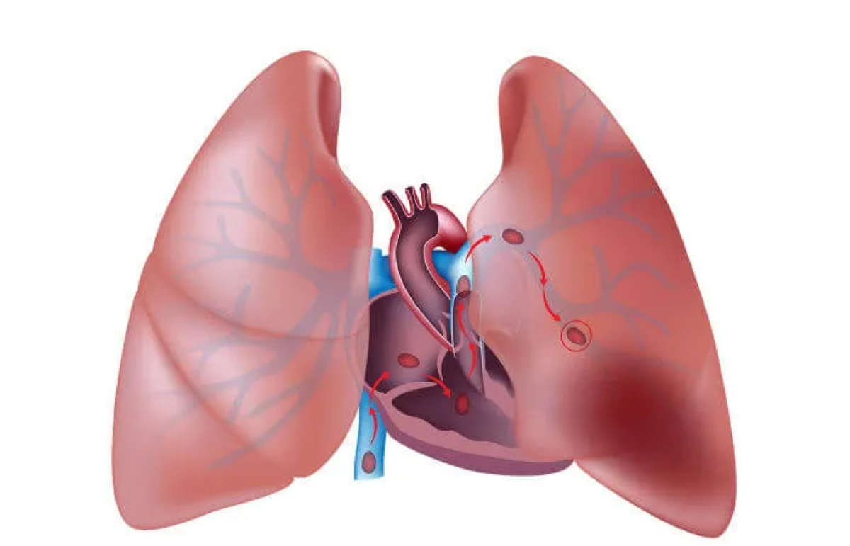 Embolia pulmonar é a terceira causa de morte cardiovascular do mundo, segundo Sociedade Internacional de Trombose e Hemostasia
