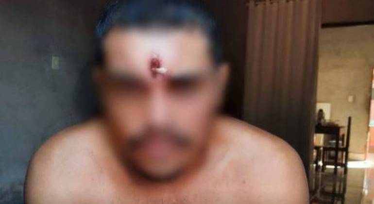 Homem é baleado na testa, vai para casa, dorme e só depois recebe atendimento médico no Tocantins