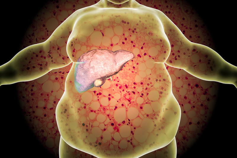 Cirurgia bariátrica reduz em 90% o risco de doença hepática, apontam estudos