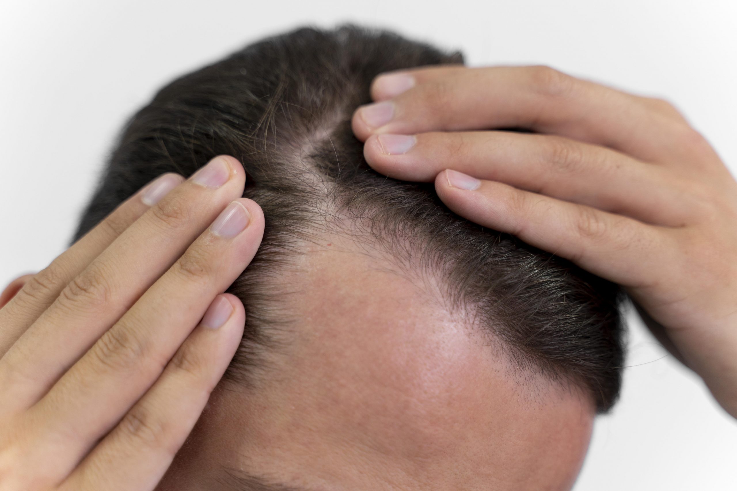 O que está por trás da queda de cabelo