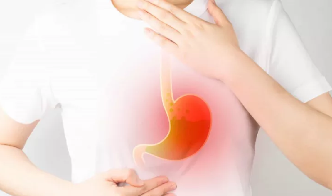 Refluxo: Azia, hérnia de hiato e tosse constante podem ser sinais de alerta