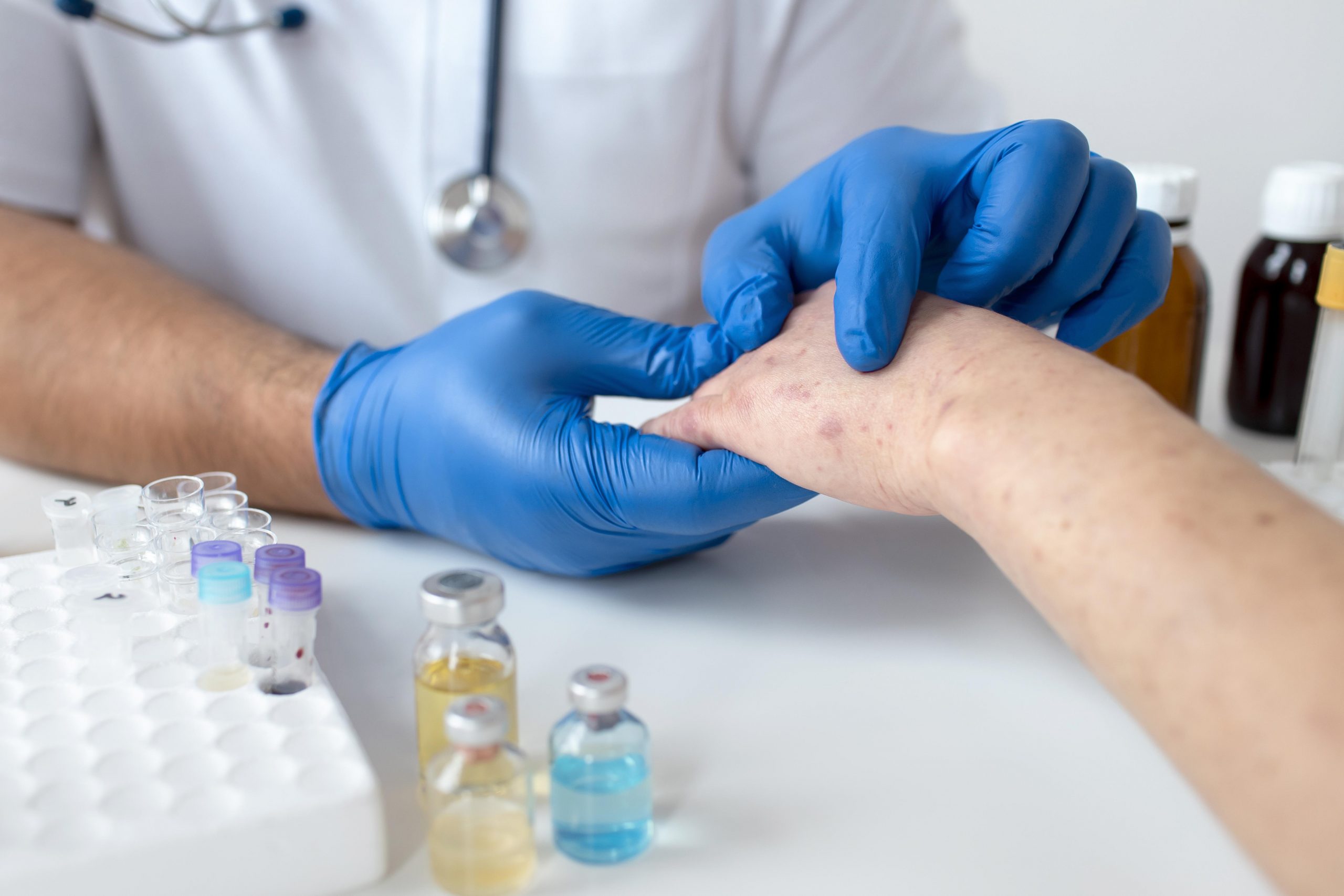 Mato Grosso confirma mais três registros de varíola dos macacos; estado totaliza 23 casos