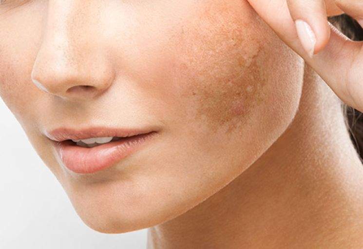 Melasma: entenda as causas e saiba como tratar as manchas no verão