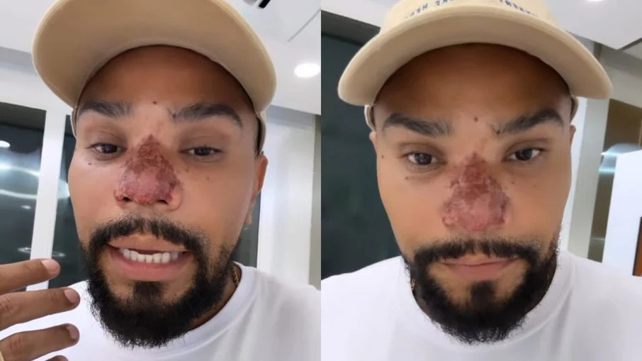 Rinomodelação e necrose: entenda o procedimento realizado por Naldo