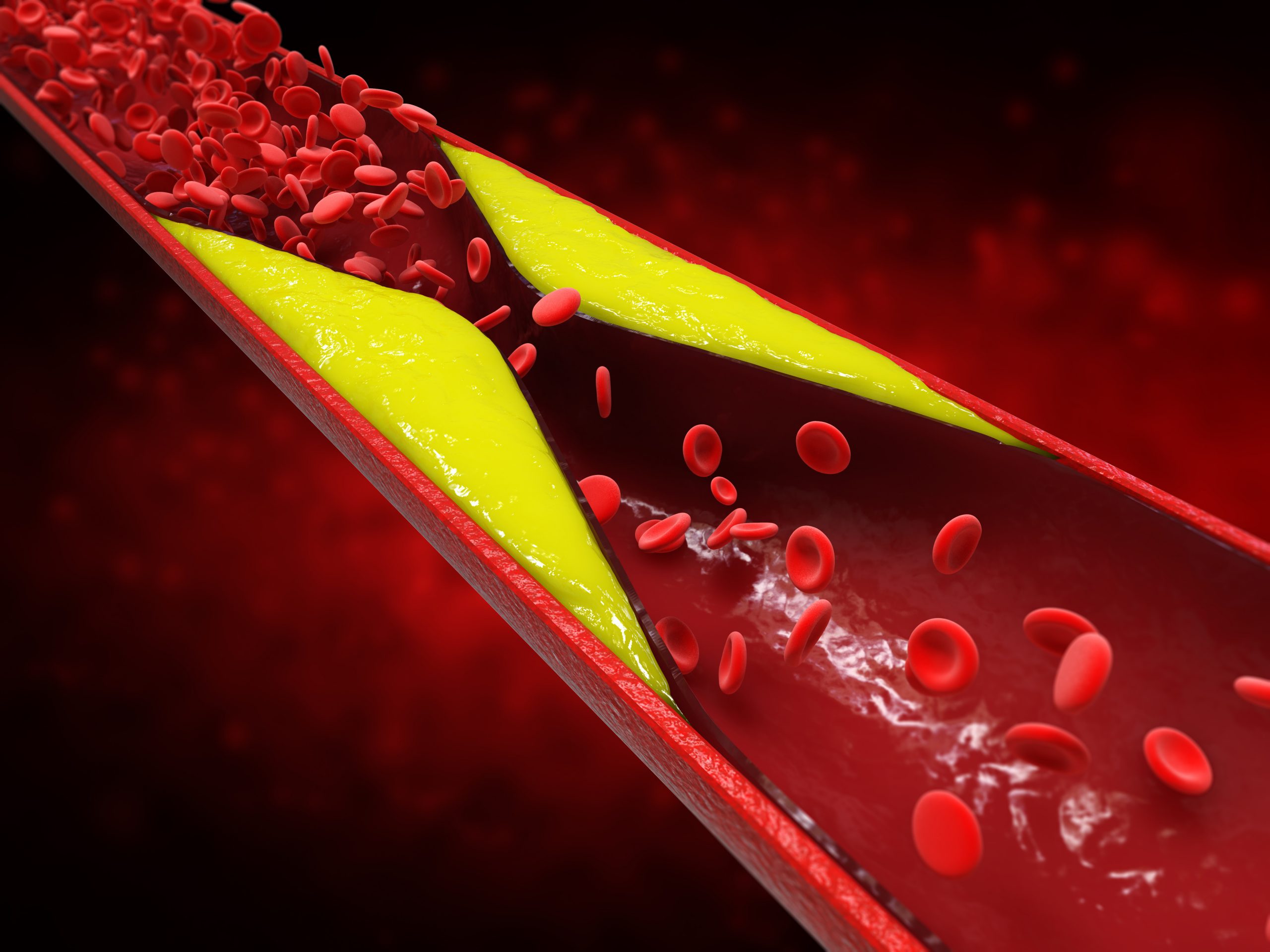 Aterosclerose e arteriosclerose representam risco à saúde arterial dos homens