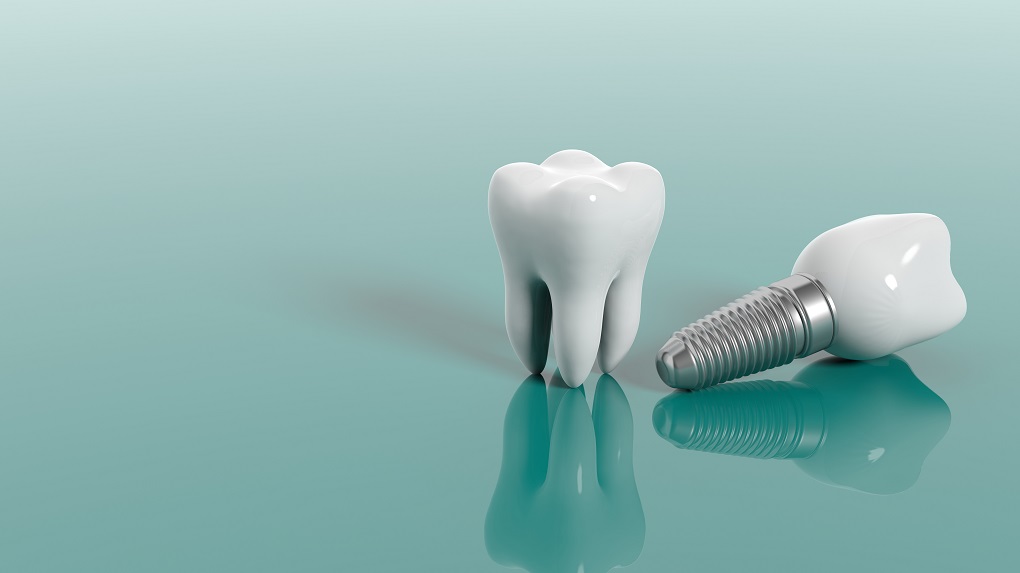 Implante dentário: 6 principais dúvidas esclarecidas
