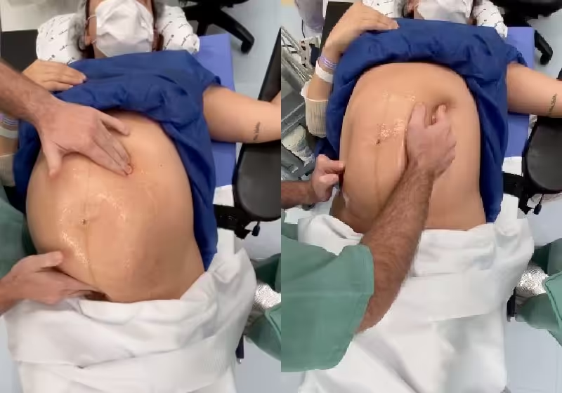 Médico consegue virar bebê na barriga da mãe, evita cesariana e vídeo viraliza