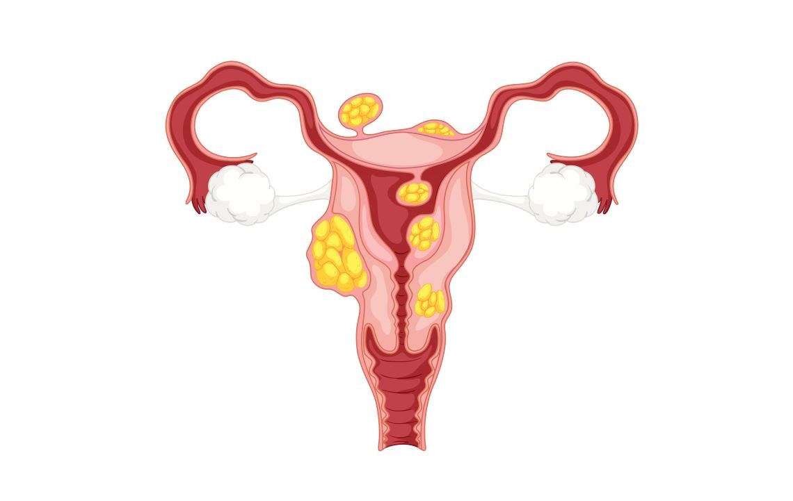 Miomas uterinos afetam até 70% das mulheres, mas raramente levam à infertilidade feminina
