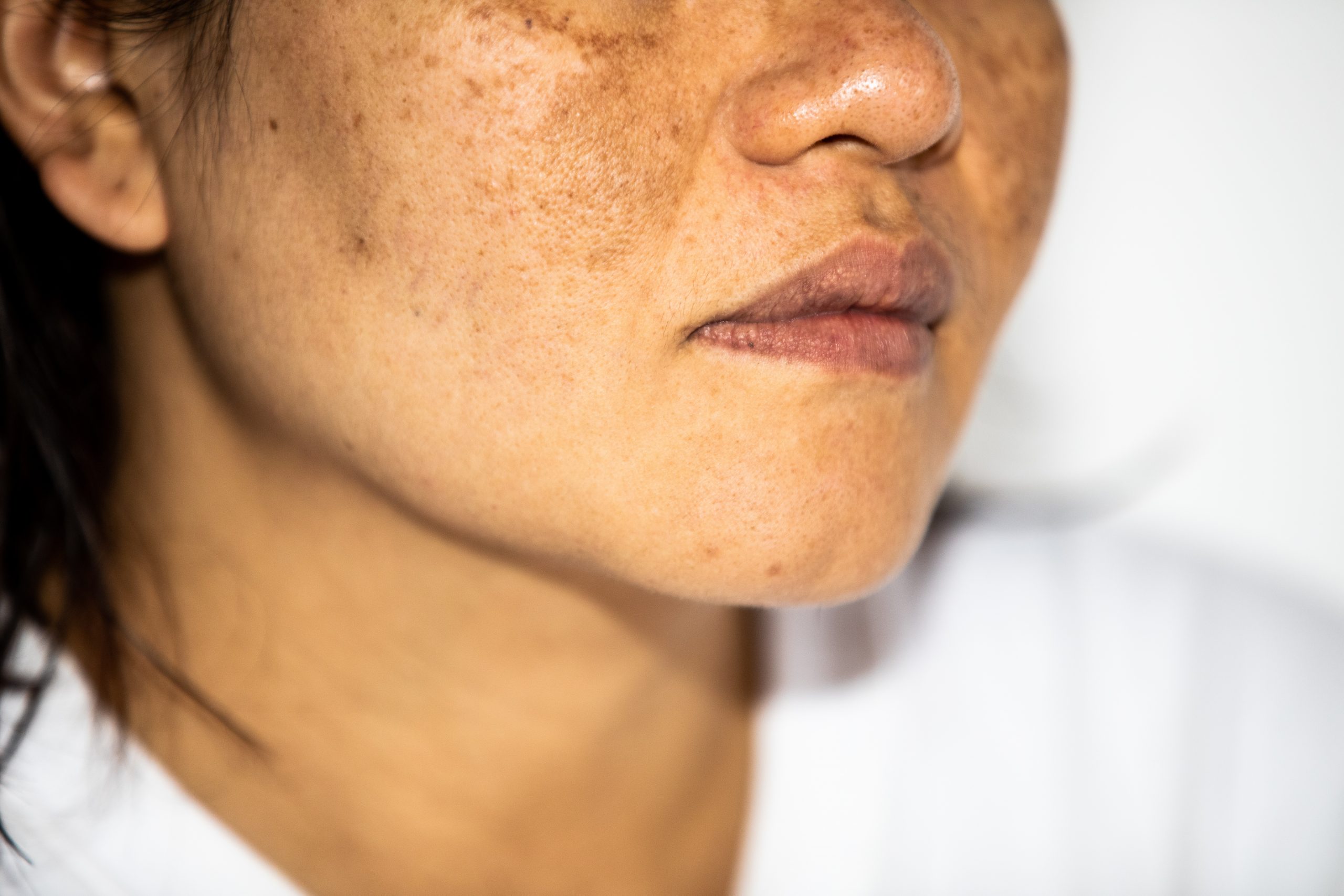 Por que a temporada de Outono e Inverno é perfeita para tratar o Melasma?