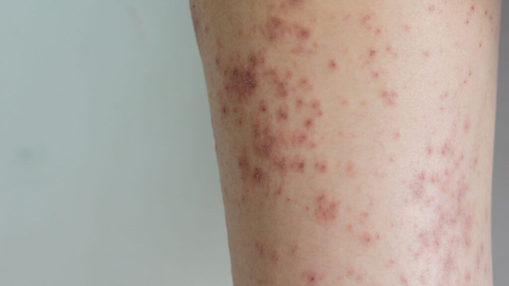 Como proteger as crianças da Febre Maculosa