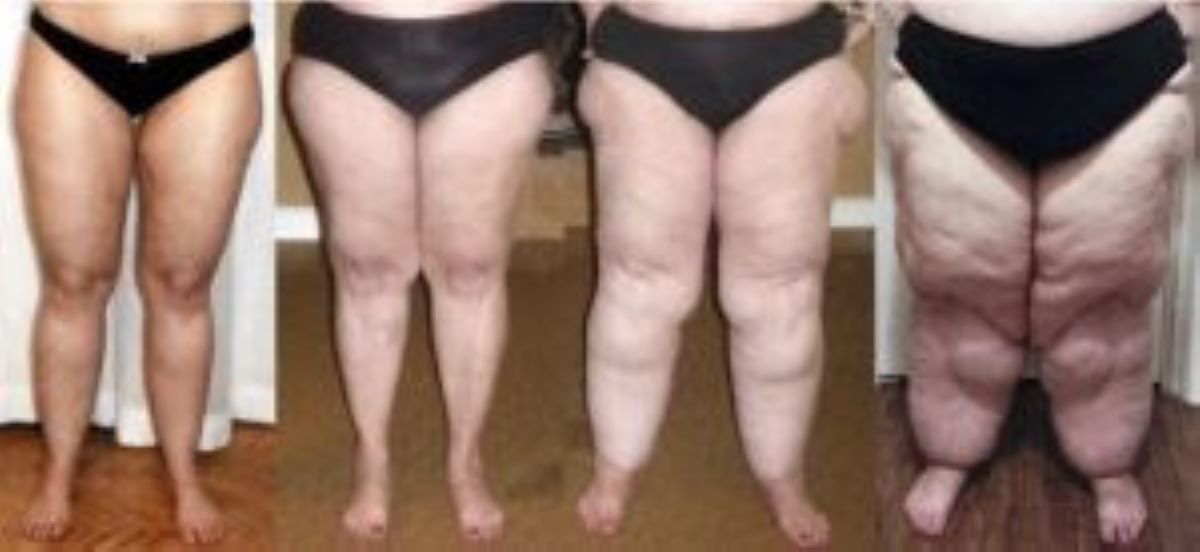 Lipedema é uma doença comum e pode impactar a qualidade de vida da mulher