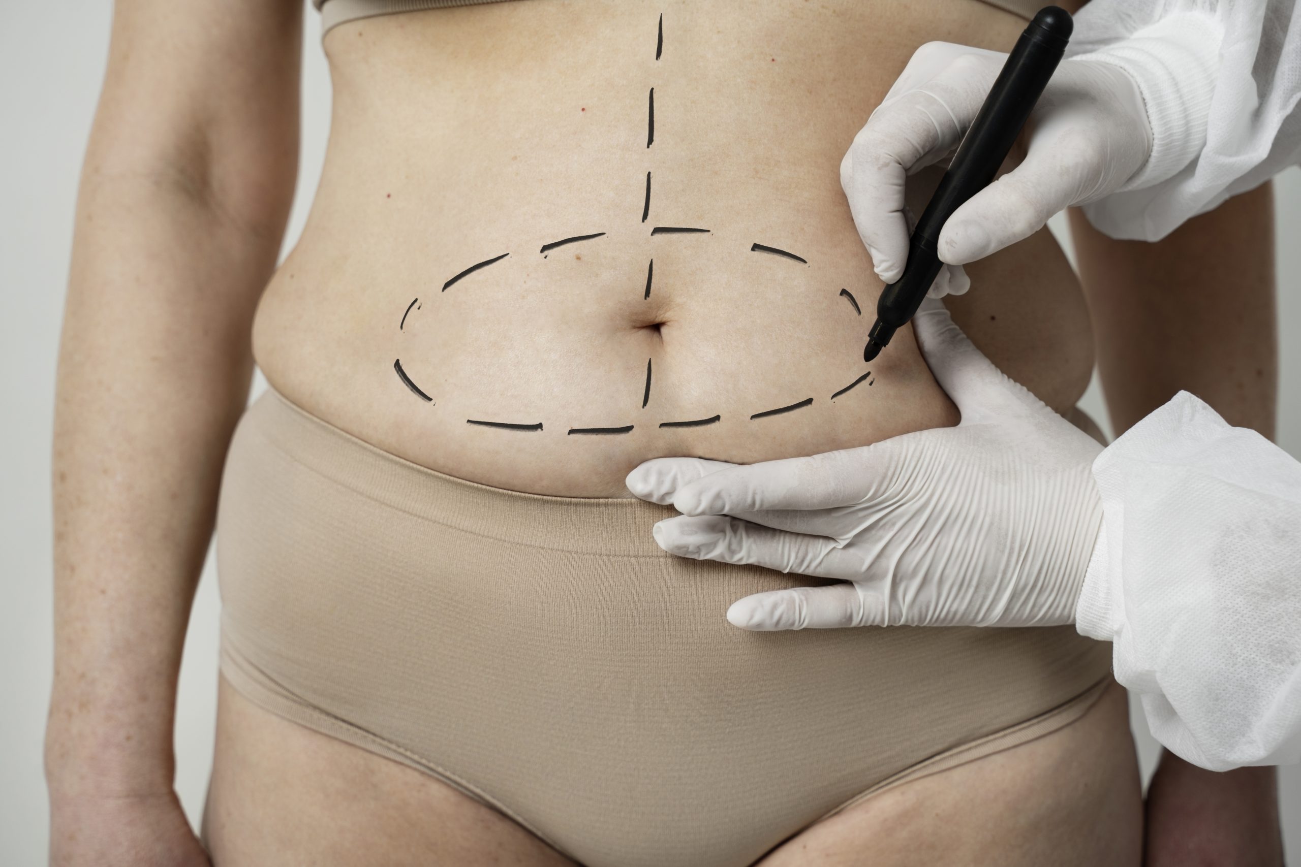 5 medos da abdominoplastia esclarecidos neste guia