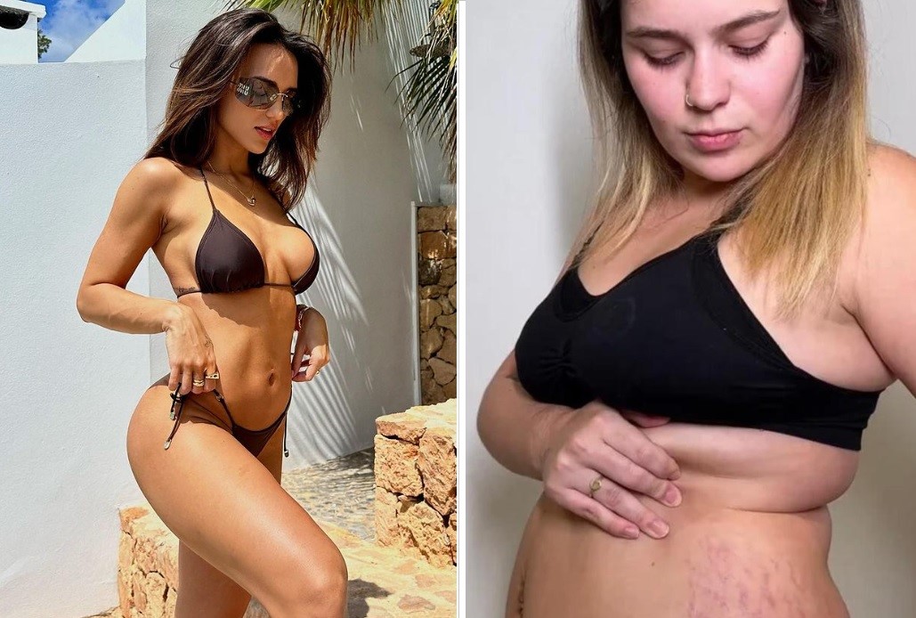 Celebridades dividem opinião sobre estrias: abalam ou não a autoestima?