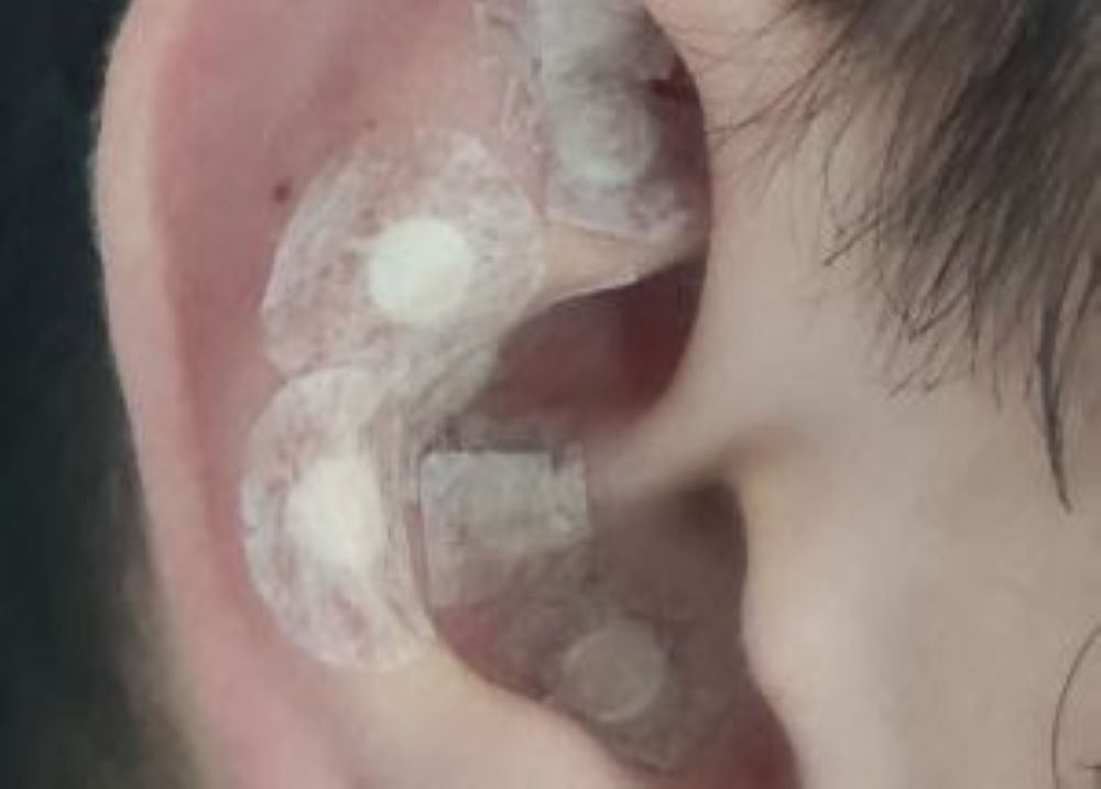 Saúde | Auriculoterapia pode tratar e até diagnosticar doenças