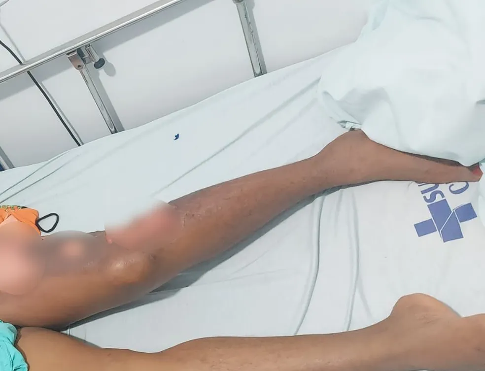 Mulher é internada com queimaduras de 2° grau após ser atingida por água fervente jogada pelo companheiro
