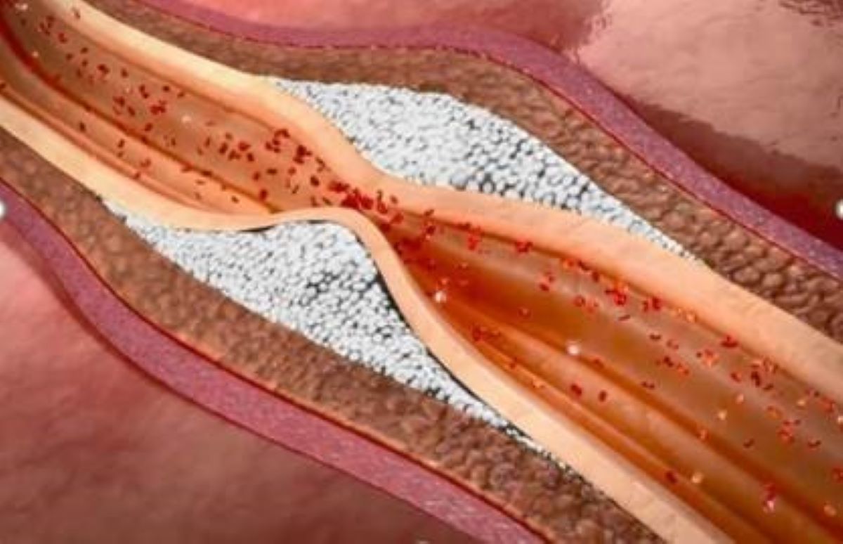 Vitamina K2 tem papel de destaque na prevenção e controle da calcificação arterial