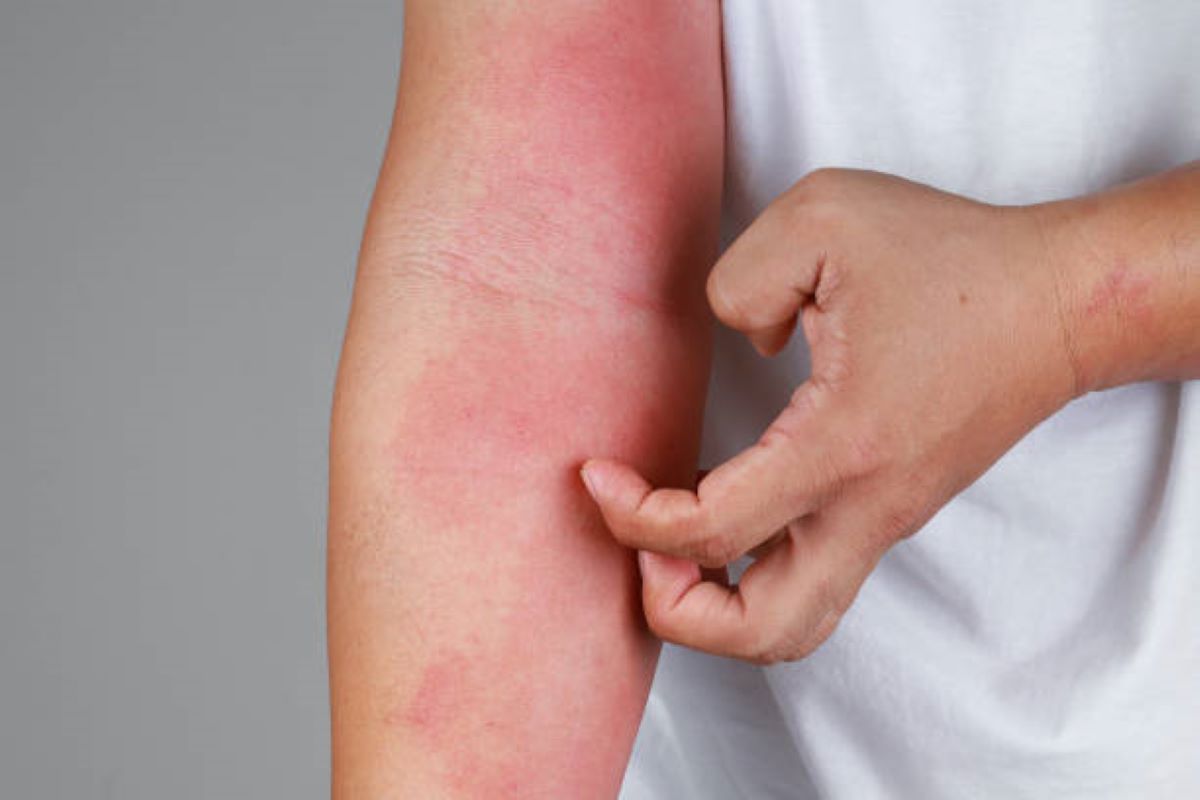 Alergia ao sol e a preservativos? Conheça estas e outras condições curiosas que merecem sua atenção