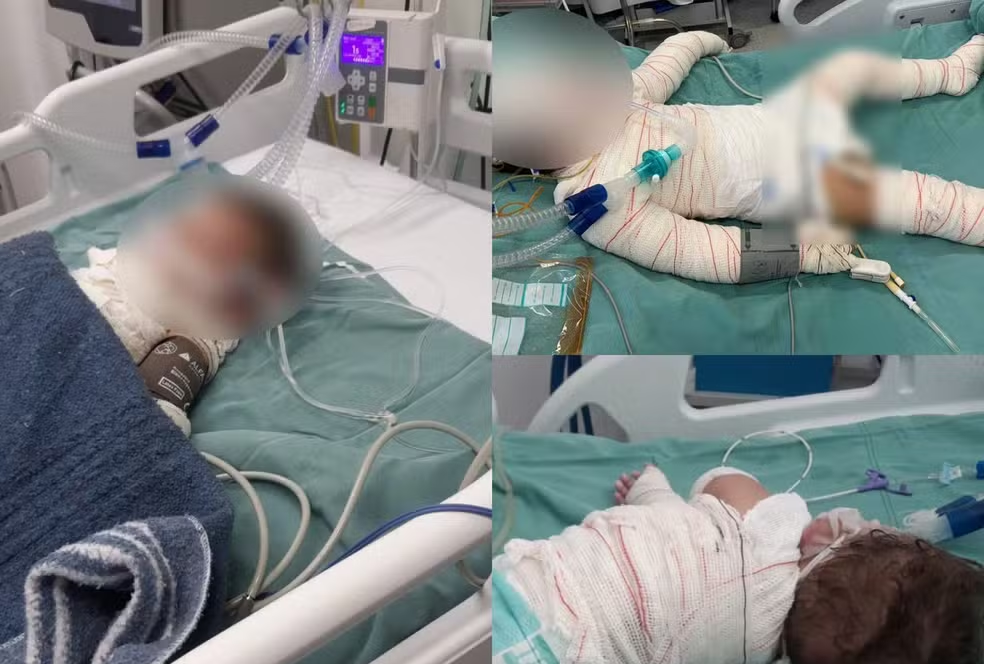 Cuiabá | Churrasqueira acesa com álcool explode e deixa mãe e filhos em estado grave