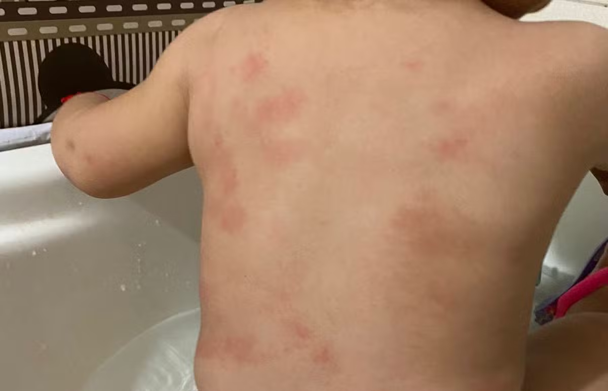 Cuiabá | Mãe denuncia creche por maus-tratos após encontrar hematomas no corpo de filha de 1 ano