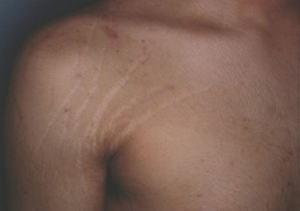 Estrias: Um Desafio Estético para os Amantes da Musculação