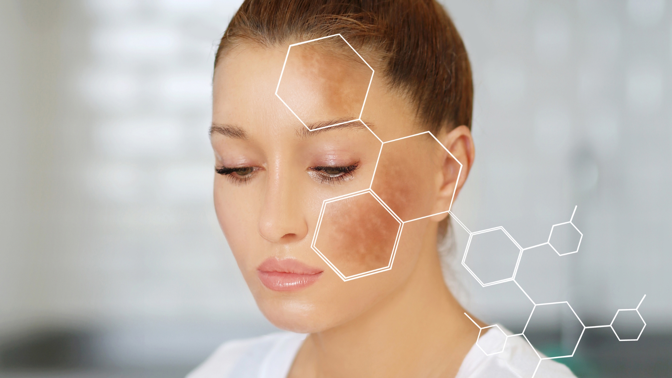 Melasma: 8 Alimentos com Compostos Bioativos e Ação Fotoprotetora